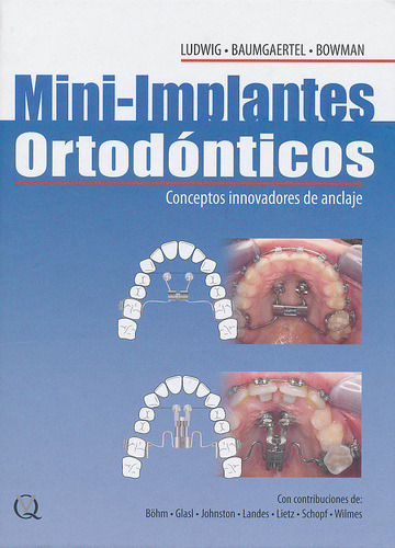 Mini-Implantes Ortodónticos - Ludwig