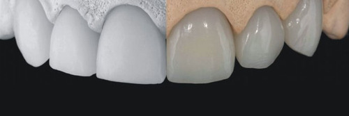 Natural Esthetic Design Smile Analysis - Adolfi