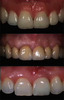 Prosthetic Material Selection for Rehabilitations in the Esthetic Zone - Gracis