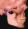 Unusual TMD Cases - Unusual Treatment - Roussou