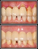 Predictable Soft Tissue Grafting for Esthetics in Thin Periodontium - Lin