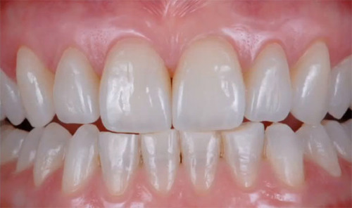 Previsualization in Esthetic Dentistry - A Useful System for Truly Informed Esthetic Treatment - Mintrone