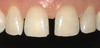 Previsualization in Esthetic Dentistry - A Useful System for Truly Informed Esthetic Treatment - Mintrone