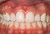 Shade Selection to Match Natural Teeth and Adjacent Restorations - Paul