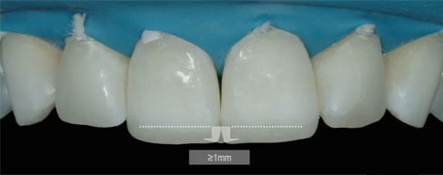 Conservative Rehabilitation of Abrasion & Erosion Cases - Dietschi