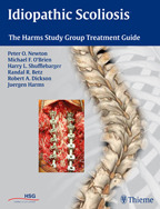 Idiopathic Scoliosis - Newton / O'Brien / Shufflebarger / Betz / Dickson / Harms