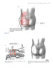 McGraw-Hill Medical, Atlas de Cirugía Plástica Contorneado Corporal - Shermak