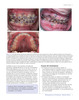 MINIIMPLANTES EN ORTODONCIA MANUAL CLINICO - Cousley