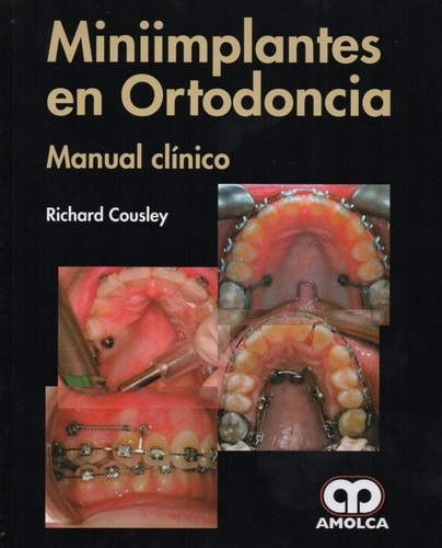 MINIIMPLANTES EN ORTODONCIA MANUAL CLINICO - Cousley