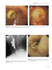 Endoscopia Gastrointestinal en Pacientes Oncológicos - Deutsch / Banks