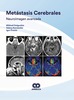 Metástasis Cerebrales. Neuroimagen avanzada - Dolgushin / Kornienko / Pronin