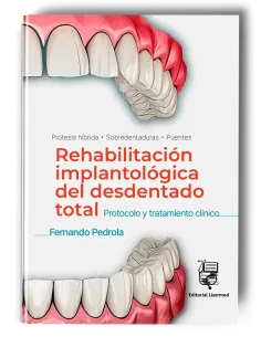 Rehabilitación Implantológica del Desdentado Total: Protocolo y Tratamiento Clínico
