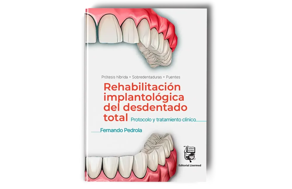Rehabilitación Implantológica del Desdentado Total: Protocolo y Tratamiento Clínico