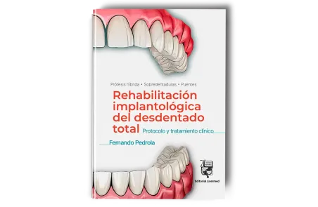 Rehabilitación Implantológica del Desdentado Total: Protocolo y Tratamiento Clínico