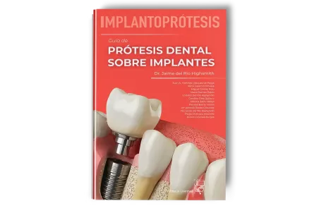 Implantoprótesis. Guía de Prótesis Dental Sobre Implantes. Jaime del Río Highgsmith - Lisermed