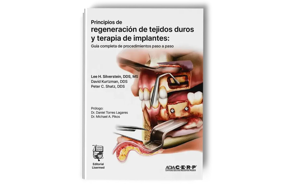 Principios de Regeneración de Tejidos Duros y Terapia de Implantes. Lee H. Silverstein - Lisermed