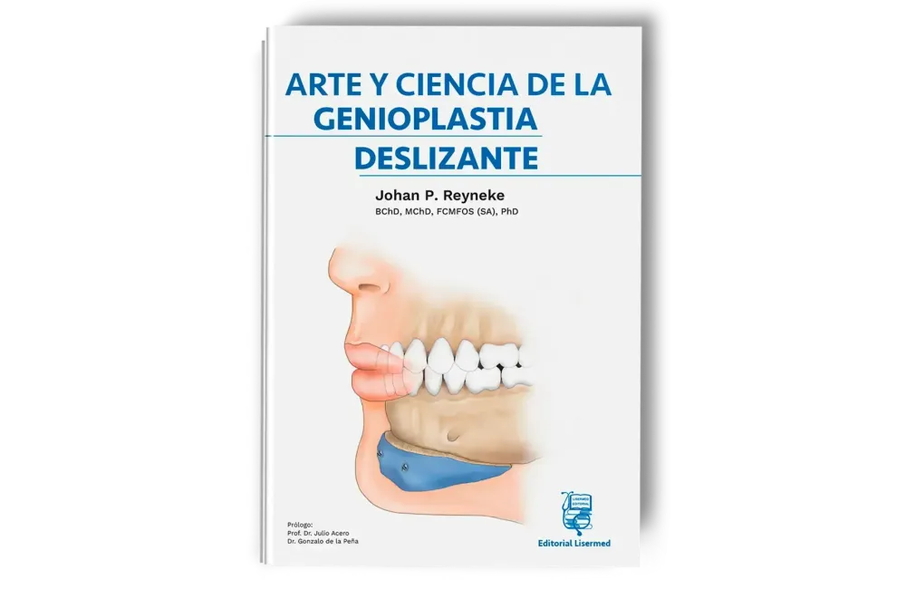 Arte y Ciencia de la Genioplastia Deslizante. Johan P. Reyneke - Lisermed