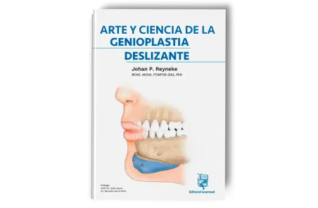Arte y Ciencia de la Genioplastia Deslizante. Johan P. Reyneke - Lisermed
