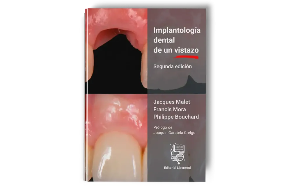 Implantología Dental de un Vistazo - Jacques Malet / Francis Mora / Philippe Bouchard