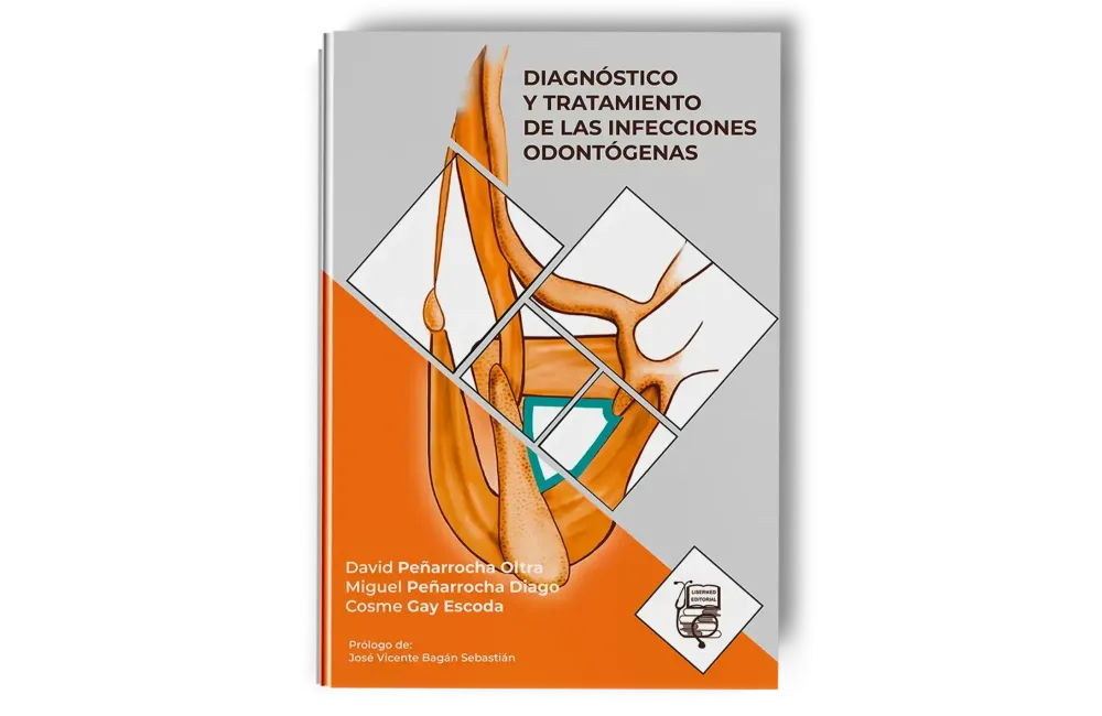 Diagnóstico y Tratamiento de la Infección Odontógena