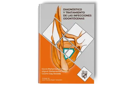 Diagnóstico y Tratamiento de la Infección Odontógena