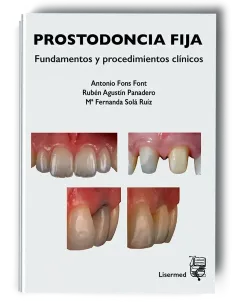 Prostodoncia Fija. Fundamentos y Procedimientos Clínicos. Antonio Fons, Rubén Agustín y Mª Fernanda Solá - Lisermed