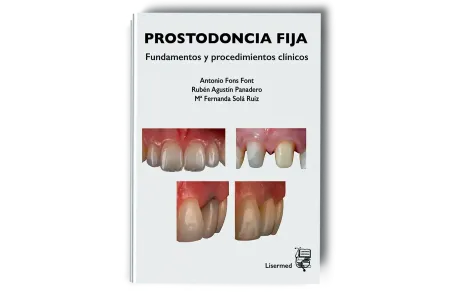 Prostodoncia Fija. Fundamentos y Procedimientos Clínicos. Antonio Fons, Rubén Agustín y Mª Fernanda Solá - Lisermed