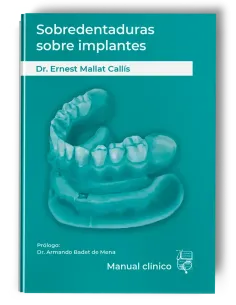 Sobredentaduras Sobre Implantes: Manual Clínico
