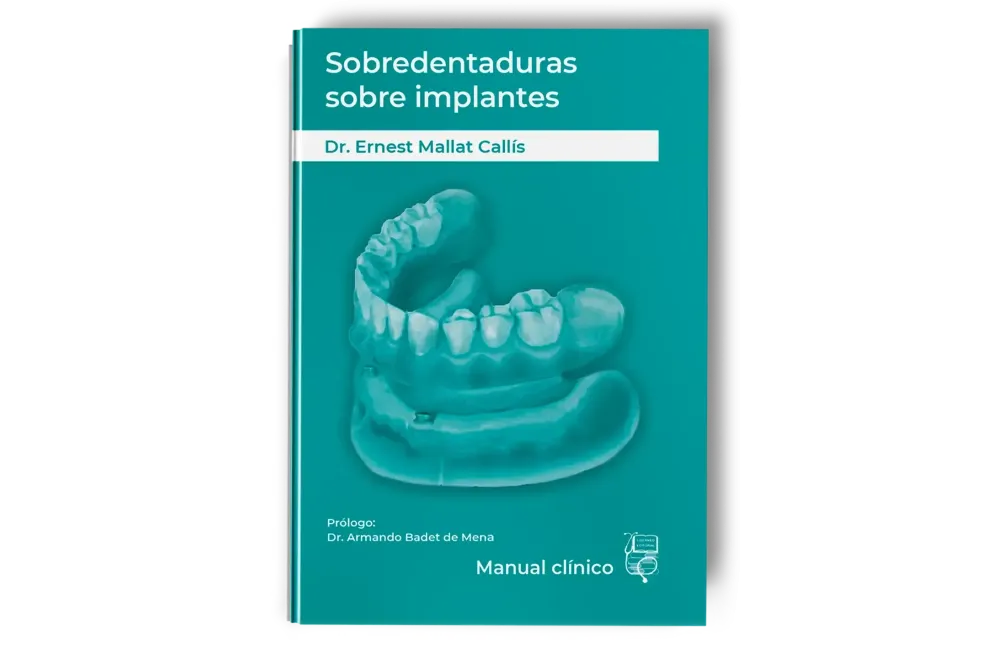 Sobredentaduras Sobre Implantes: Manual Clínico