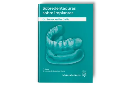 Sobredentaduras Sobre Implantes: Manual Clínico