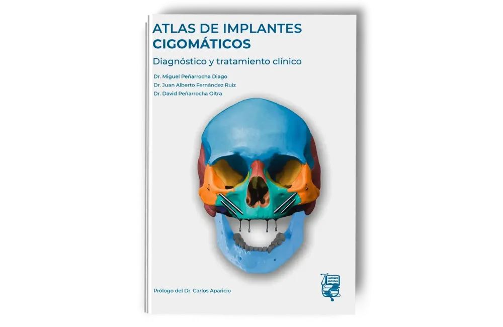 Atlas de Implantes Cigomáticos. Miguel Peñarrocha / Alberto Fernández / David Peñarrocha - Lisermed