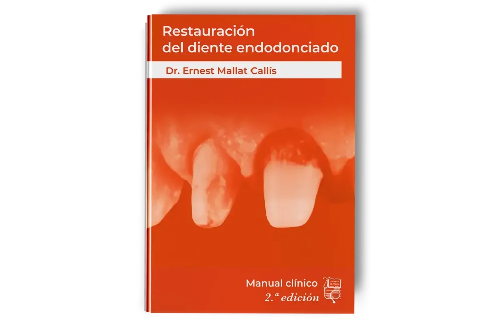 Restauración del Diente Endodonciado Manual Clínico. Ernest Mallat -Lisermed