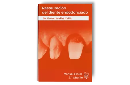 Restauración del Diente Endodonciado Manual Clínico. Ernest Mallat -Lisermed