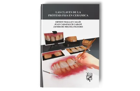 Las Claves de la Prótesis Fija en Cerámica - Ernest Mallat Callís / Juan Cadafalch Cabaní / Javier de Miguel Figuero - Lisermed