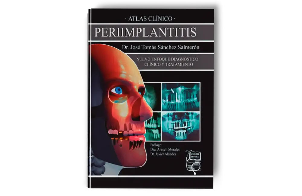 Atlas Clínico · Periimplantitis. José Sánchez Salmerón - Lisermed