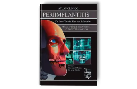 Atlas Clínico · Periimplantitis. José Sánchez Salmerón - Lisermed