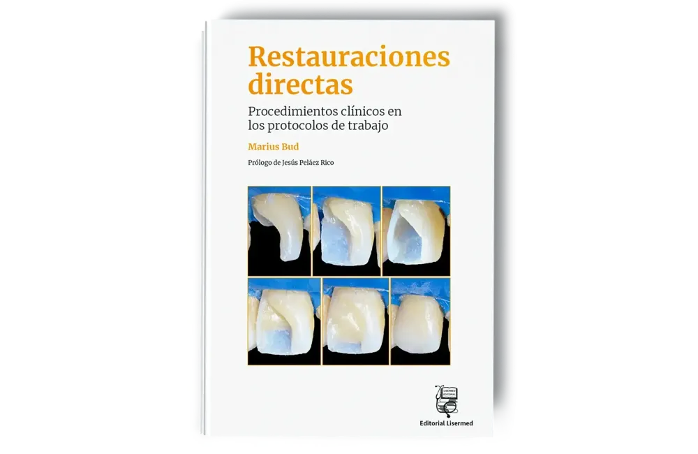 Restauraciones directas. Procedimientos clínicos en los protocolos de trabajo - Marius Bud - Lisermed