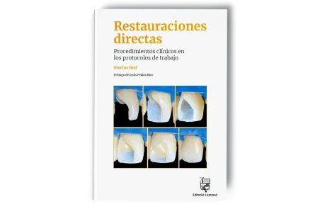 Restauraciones directas. Procedimientos clínicos en los protocolos de trabajo - Marius Bud - Lisermed