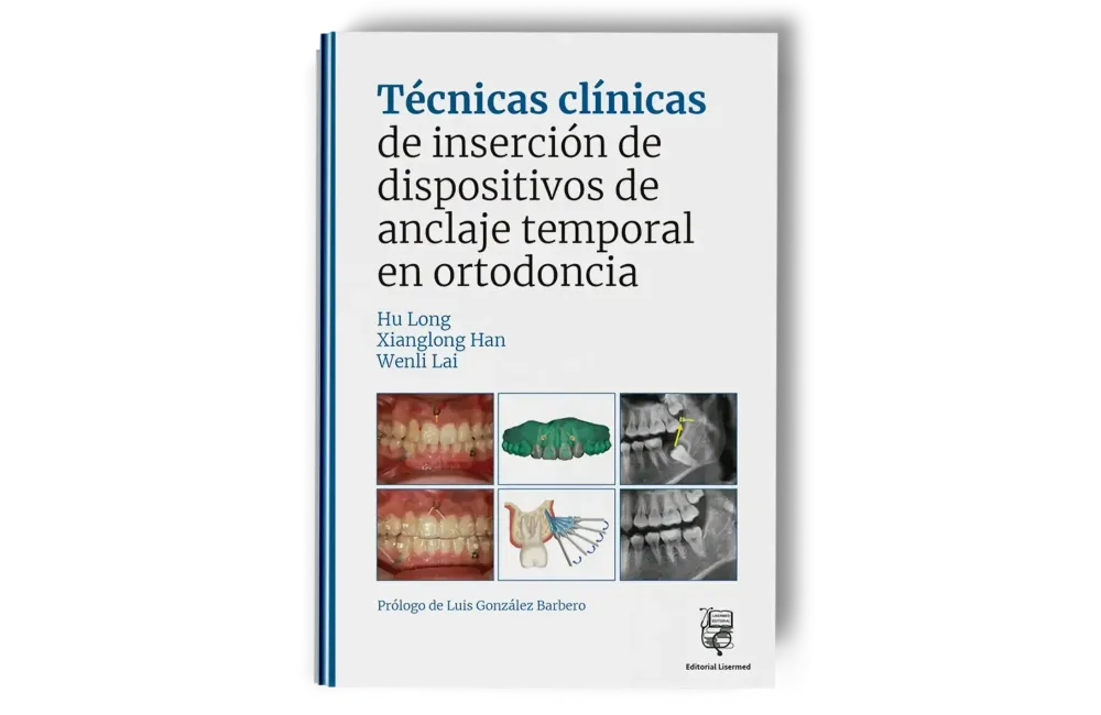 Técnicas clínicas de dispositivos de anclaje temporal en ortodoncia