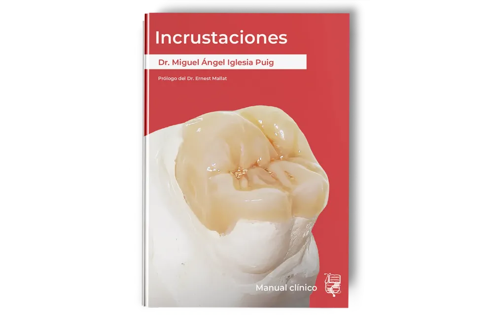 Incrustaciones - Manual clínico