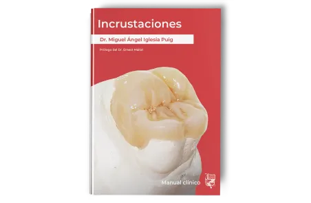 Incrustaciones - Manual clínico