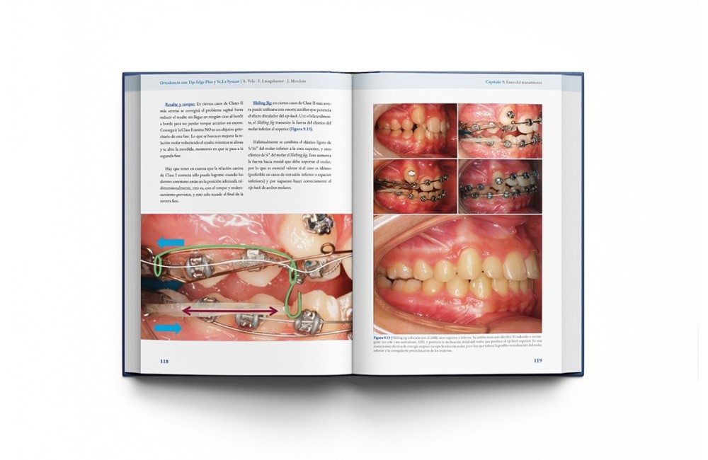 Ortodoncia con Tip-Edge Plus y Ve.La System