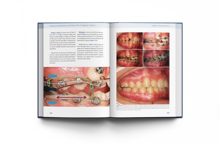 Ortodoncia con Tip-Edge Plus y Ve.La System