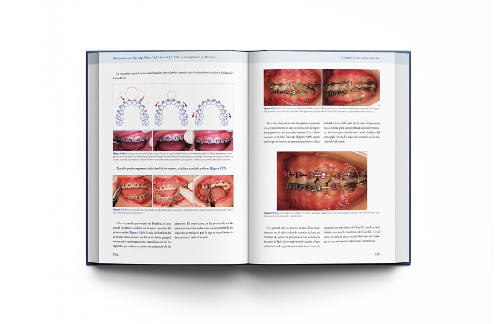 Ortodoncia con Tip-Edge Plus y Ve.La System