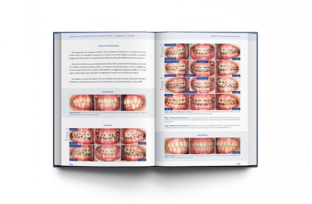 Ortodoncia con Tip-Edge Plus y Ve.La System