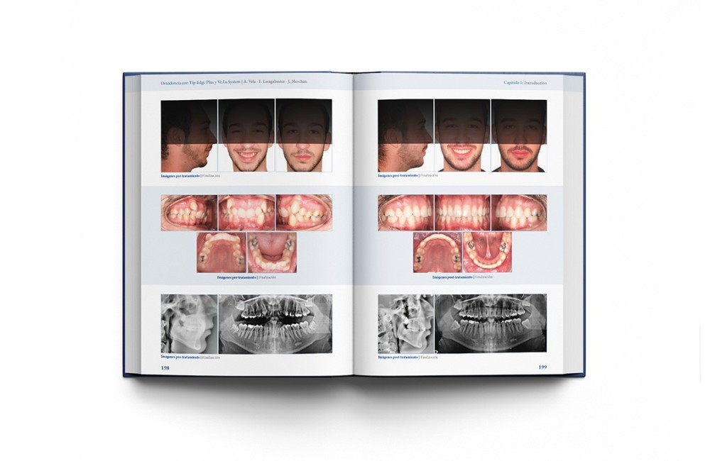 Ortodoncia con Tip-Edge Plus y Ve.La System