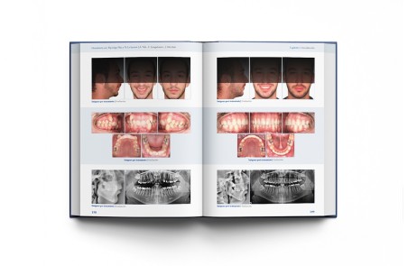 Ortodoncia con Tip-Edge Plus y Ve.La System