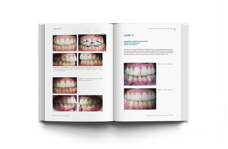 Alineadores Invisibles: Los Secretos de la Estética Transparente