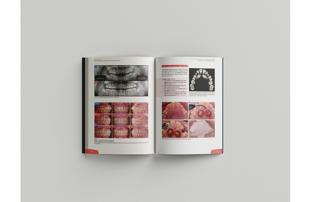 Miniscrew applications in orthodontics