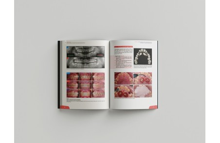 Miniscrew applications in orthodontics